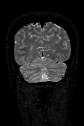 Cerebral arteriovenous malformation at posterior body of corpus callosum (Radiopaedia 74111-84925 Coronal T2 151).jpg