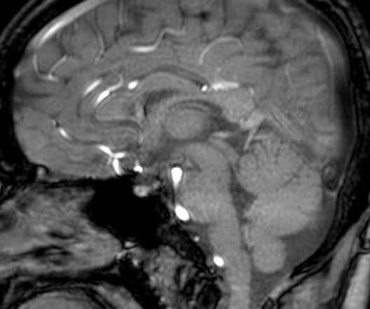 Cerebral arteriovenous malformation at posterior body of corpus callosum (Radiopaedia 74111-84925 J 193).jpg