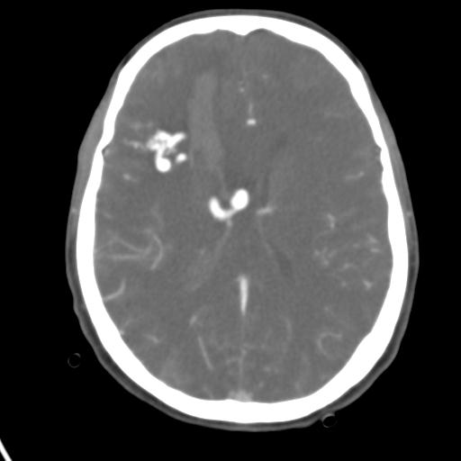 Cerebral arteriovenous malformation with hemorrhage (Radiopaedia 28773-29073 A 24).jpg