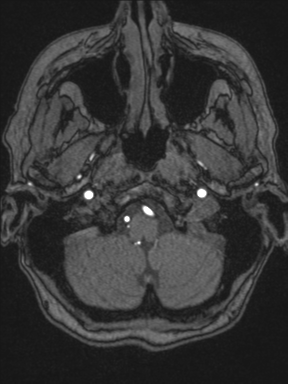 Cerebral arteriovenous malformation with hemorrhage (Radiopaedia 34422-35737 Axial MRA 8).png