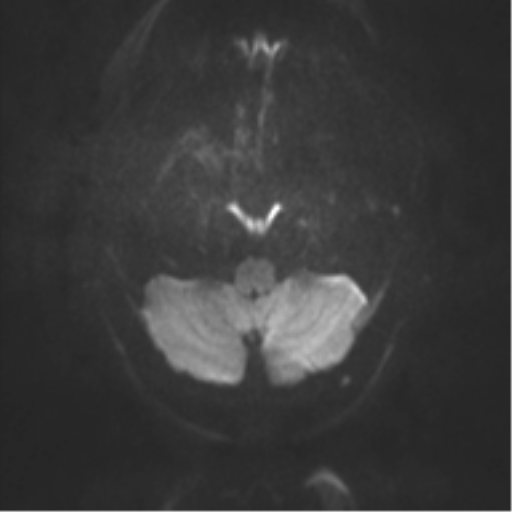 File:Cerebral cavernoma and development venous anomaly (Radiopaedia 37603-39482 Axial DWI 27).png