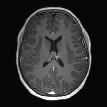 Cerebral cavernous venous malformation (Radiopaedia 70008-80021 Axial T1 C+ 47).jpg