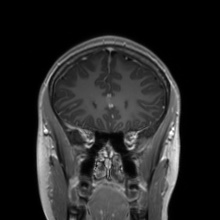 Cerebral cavernous venous malformation (Radiopaedia 70008-80021 Coronal T1 C+ 45).jpg