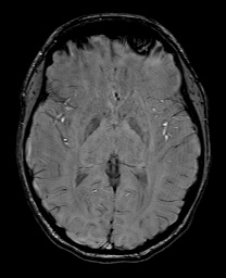 File:Cerebral cavernous venous malformation (Radiopaedia 70008-80021 I 37).jpg