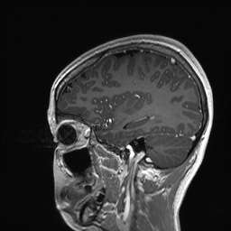 Cerebral cavernous venous malformation (Radiopaedia 70008-80021 Sagittal T1 C+ 20).jpg