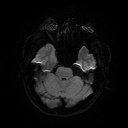 File:Cerebral cavernous venous malformation (Zabramski type II) (Radiopaedia 85511-101198 Axial DWI 11).jpg