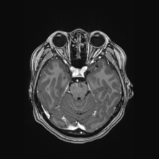 Cerebral cavernous venous malformations (Radiopaedia 48117-52946 Axial T1 C+ 17).png