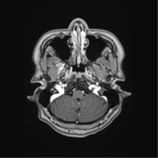 Cerebral cavernous venous malformations (Radiopaedia 48117-52946 Axial T1 C+ 3).png