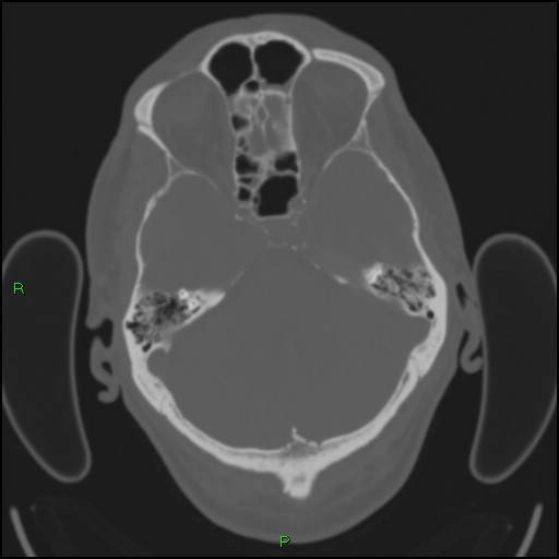 File:Cerebral contusions (Radiopaedia 33868-35039 Axial bone window 56).jpg