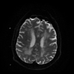 Cerebral embolic infarcts (embolic shower) (Radiopaedia 49837-55108 Axial DWI 16).jpg