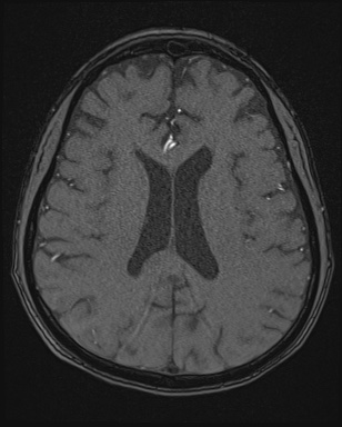 Cerebral embolic infarcts (embolic shower) (Radiopaedia 72391-82921 Axial MRA 121).jpg