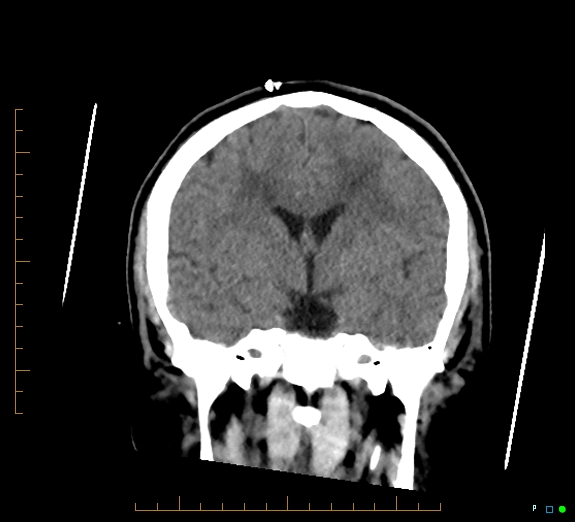 Cerebral fat embolism (Radiopaedia 85521-101220 Coronal non-contrast 31).jpg