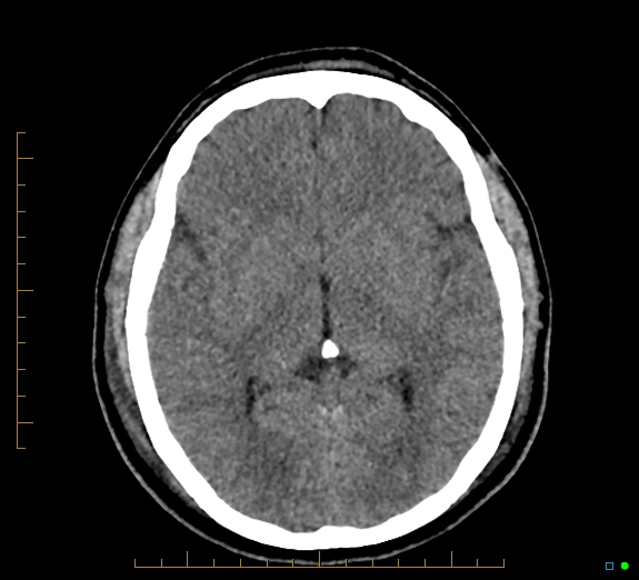 Cerebral fat embolism (Radiopaedia 85521-101224 Axial non-contrast 25).jpg