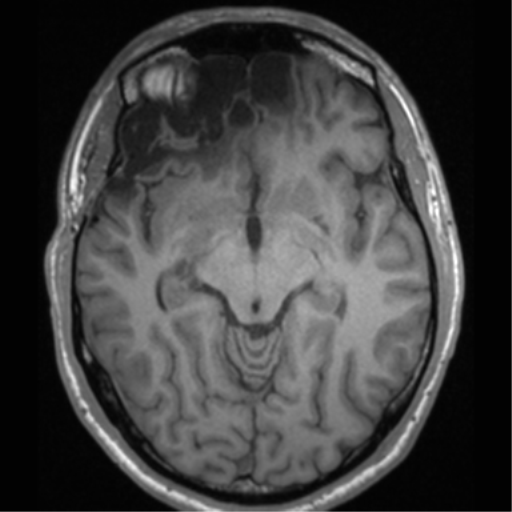 File:Cerebral hemorrhagic contusions- temporal evolution (Radiopaedia 40224-42757 Axial T1 33).png