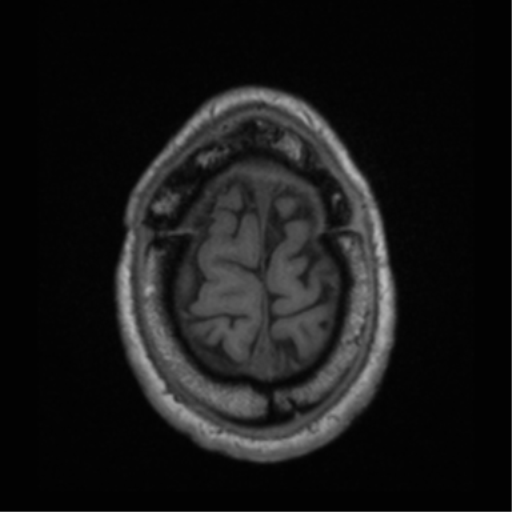 File:Cerebral hemorrhagic contusions- temporal evolution (Radiopaedia 40224-42757 Axial T1 70).png