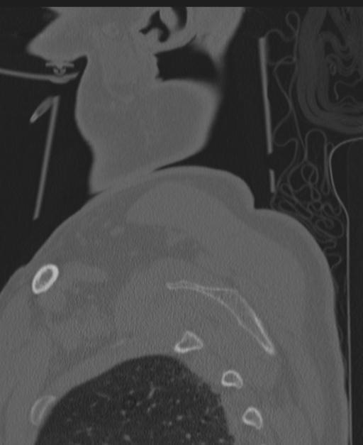 Cerebral hemorrhagic contusions and cervical spine fractures (Radiopaedia 32865-33841 Sagittal bone window 102).jpg