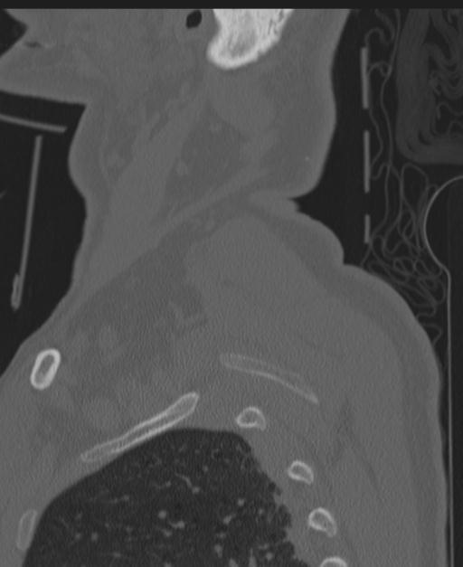 Cerebral hemorrhagic contusions and cervical spine fractures (Radiopaedia 32865-33841 Sagittal bone window 95).jpg