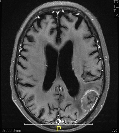 File:Cerebral metastases (Radiopaedia 17242-16946 Axial T1 C+ fat sat 1).jpg