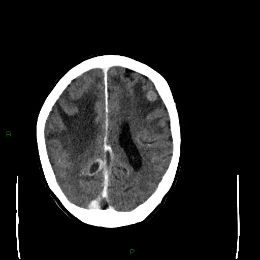 Cerebral metastases - breast primary (Radiopaedia 77653-89857 Axial C+ delayed 76).jpg