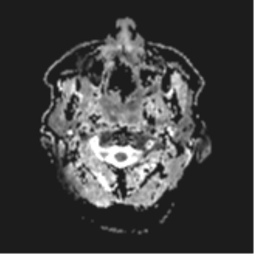 File:Cerebral metastases mimicking abscesses (Radiopaedia 45841-50131 Axial ADC 1).png