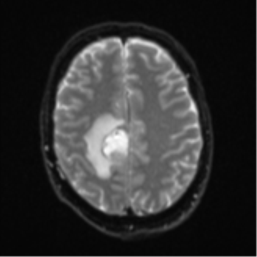 Cerebral metastasis - colorectal adenocarcinoma (Radiopaedia 50394-55765 Axial DWI 20).png
