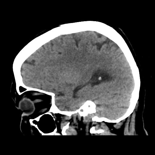 Cerebral metastasis to basal ganglia (Radiopaedia 81568-95412 E 42).png