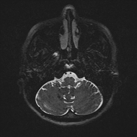 Cerebral ring enhancing lesions - cerebral metastases (Radiopaedia 44922-48817 F 12).jpg