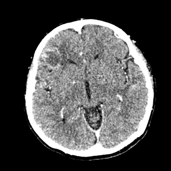 Cerebral ring enhancing lesions - cerebral metastases (Radiopaedia 44922-48818 B 136).jpg