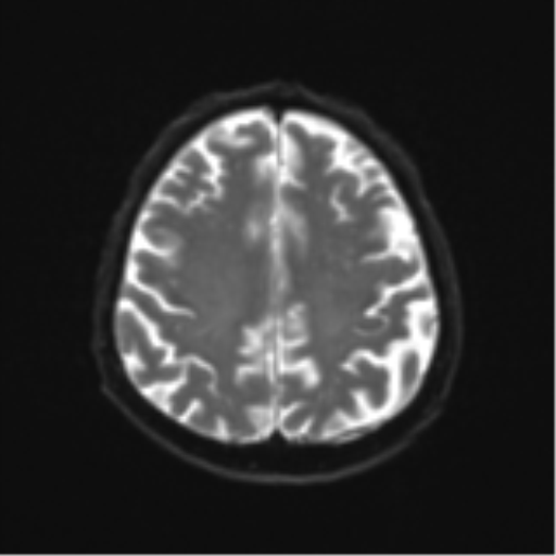 Cerebral toxoplasmosis (Radiopaedia 54575-60804 Axial DWI 24).png