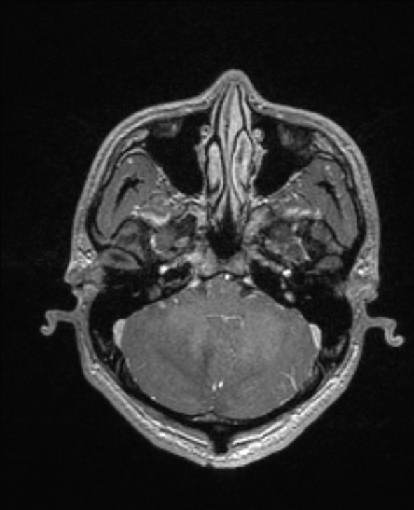 Cerebral toxoplasmosis (Radiopaedia 85779-101597 Axial T1 C+ 36).jpg