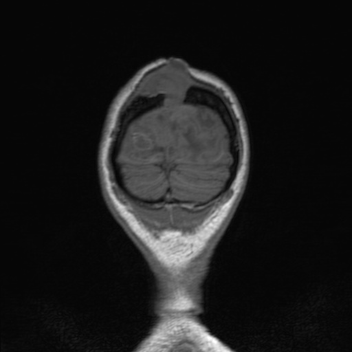 Cerebral tuberculosis with dural sinus invasion (Radiopaedia 60353-68090 Coronal T1 166).jpg