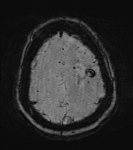 Cerebral venous infarct (Radiopaedia 53627-59685 Axial SWI 45).jpg