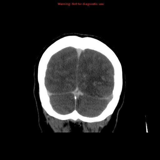 Cerebral venous infarction (Radiopaedia 12404-20735 B 72).jpg