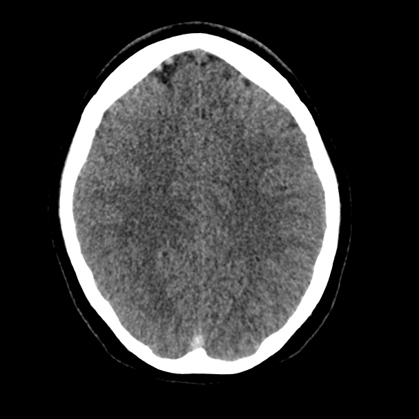 Cerebral venous sinus thrombosis (Radiopaedia 59224-66551 Axial non-contrast 29).jpg