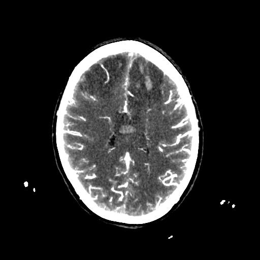 File:Cerebral venous throbmosis - hemorrhagic venous infarction (Radiopaedia 87318-103613 B 26).jpg