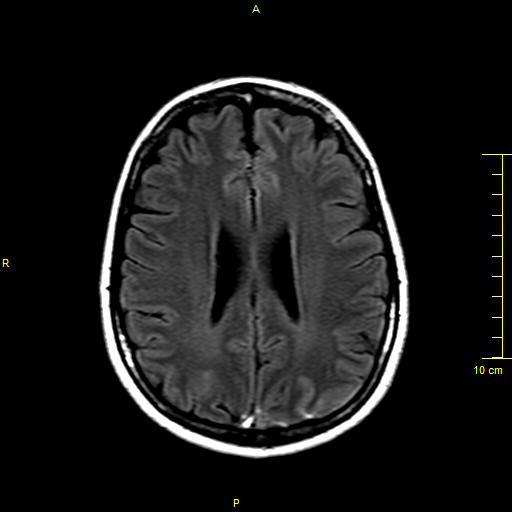 File:Cerebral venous thrombosis (Radiopaedia 23288-23351 Axial FLAIR 13).JPG