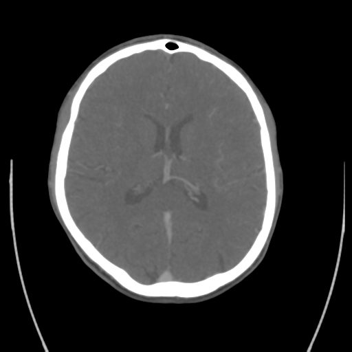 File:Cerebral venous thrombosis (Radiopaedia 38392-40467 Coronal CTA-Venogram 1).png