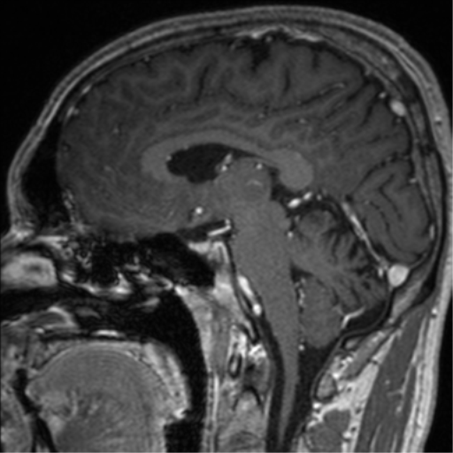 File:Cerebral venous thrombosis (Radiopaedia 38392-40469 Sagittal T1 C+ 43).png