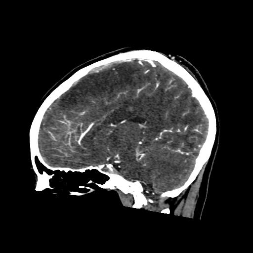 File:Cerebral venous thrombosis - hemorrhagic venous infarction (Radiopaedia 87318-103613 Sagittal 5).jpg