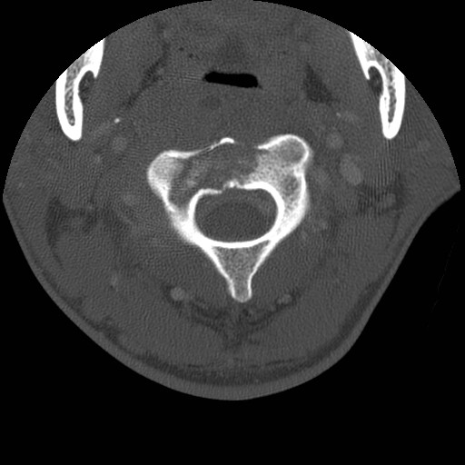 Cervical Pott disease (Radiopaedia 20374-20286 Axial bone window 36).jpg
