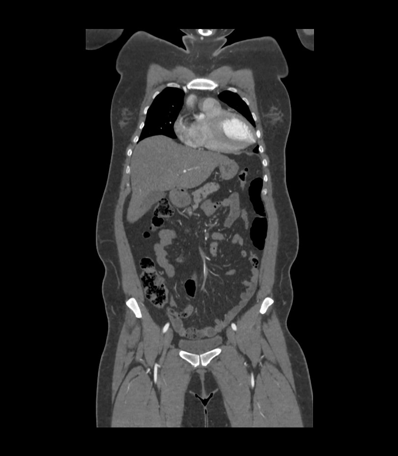 Cervical aortic arch with coarctation and aneurysms (Radiopaedia 44035-47552 C 34).jpg