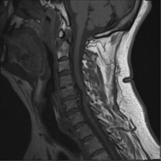 File:Cervical canal stenosis due to ossification of the posterior longitudinal ligament (Radiopaedia 47260-51824 Sagittal T1 9).png