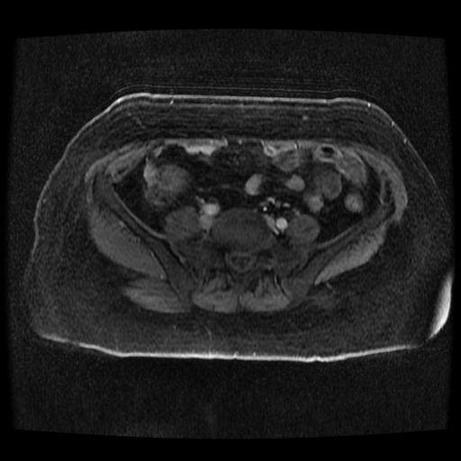 Cervical carcinoma (Radiopaedia 70924-81132 Axial T1 C+ fat sat 167).jpg
