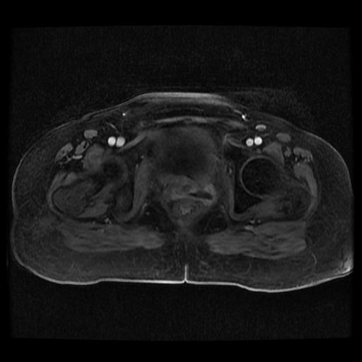 Cervical carcinoma (Radiopaedia 70924-81132 Axial T1 C+ fat sat 35).jpg