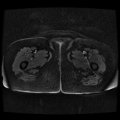 Cervical carcinoma (Radiopaedia 70924-81132 Axial T1 C+ fat sat 95).jpg