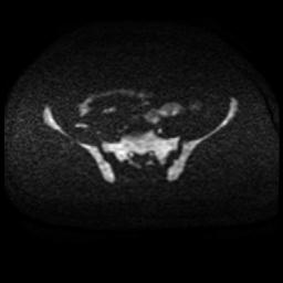 Cervical carcinoma (Radiopaedia 88010-104555 Axial DWI 80).jpg
