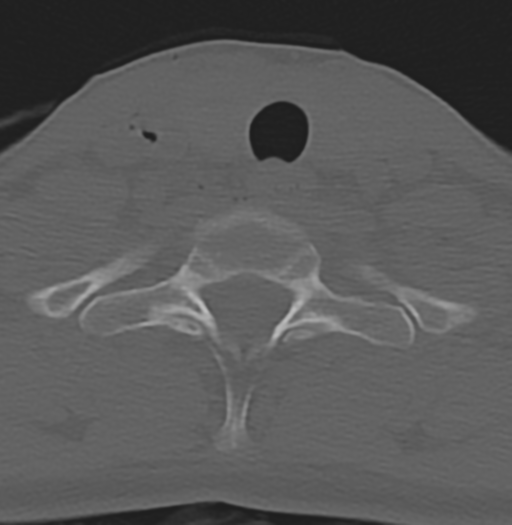 File:Cervical disc replacement (Radiopaedia 37383-39205 Axial bone window 17).png