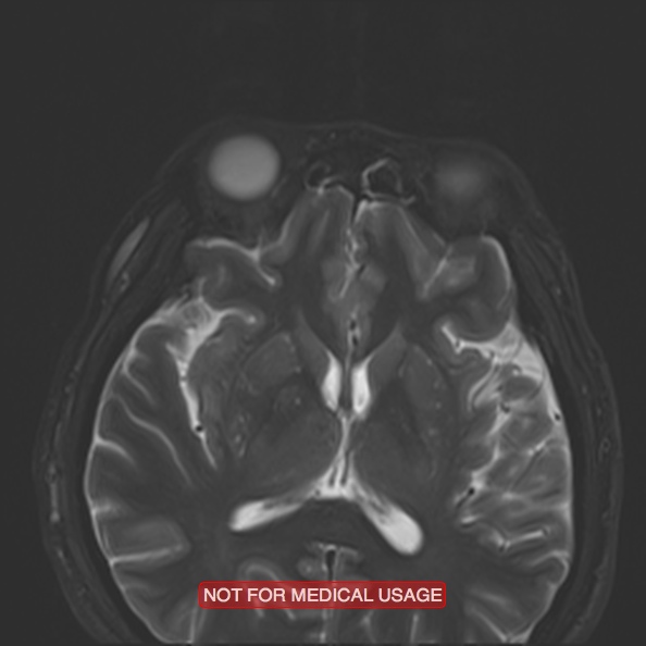 Cervical nerve schwannoma (Radiopaedia 27964-28221 C 5).jpg