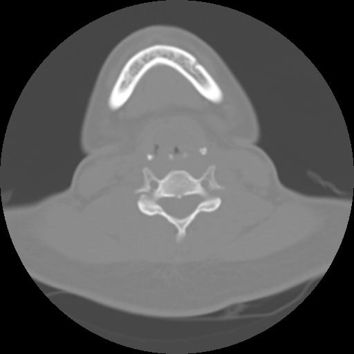 Cervical rib (Radiopaedia 71110-81363 Axial non-contrast 35).jpg