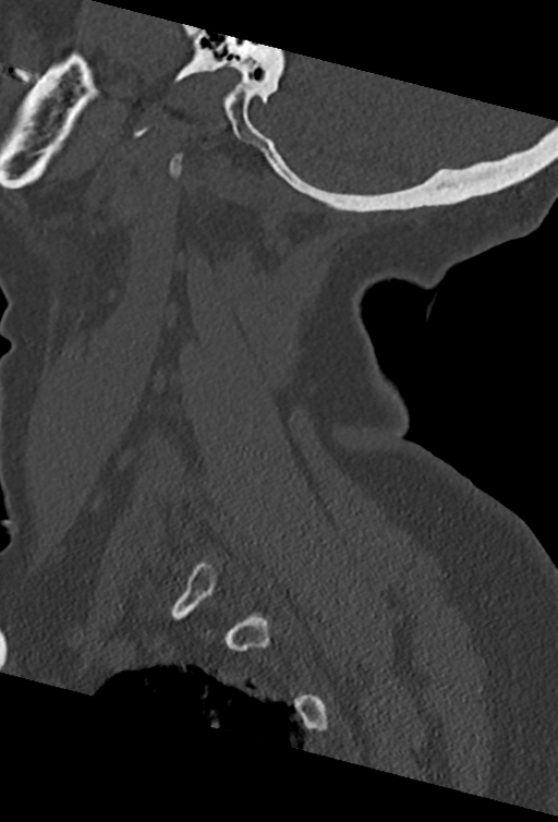 Cervical spine ACDF loosening (Radiopaedia 48998-54070 Sagittal bone window 20).png